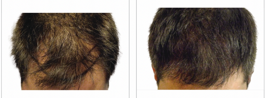 Hair Transplant | Aliestetic