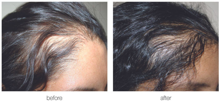 Hair Transplant | Aliestetic