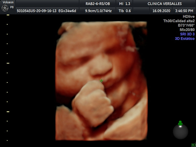 20 semanas ultrasonido 3d