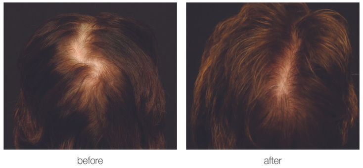 Hair Transplant | Aliestetic