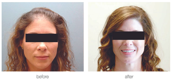 Hair Transplant | Aliestetic