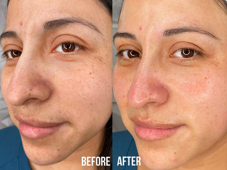 Hydrafacial | Aliestetic 