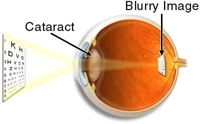 Cataract-and-Blurred-Vision.jpeg