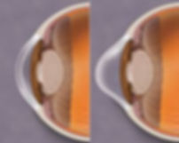 Keratoconus Cornea