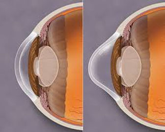 Keratoconus Cornea