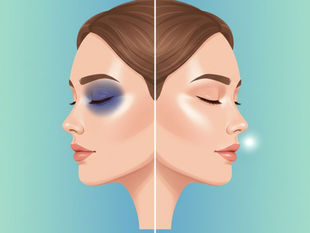 Göz Altı Sürüklenmesi ve Morluklara Elveda: Dr. Özgen Yıldırım Göz Altı Dolgusu Protokolü