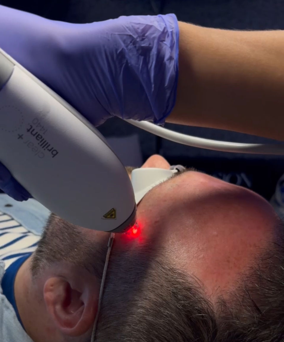 Clear And Brilliant Laser Facial