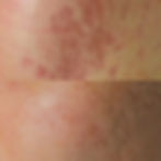 skinpen microneedling in astoria new york