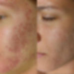 skinpen microneedling in astoria new york