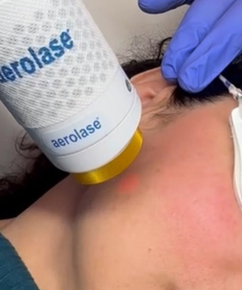 Aerolase Laser Facial