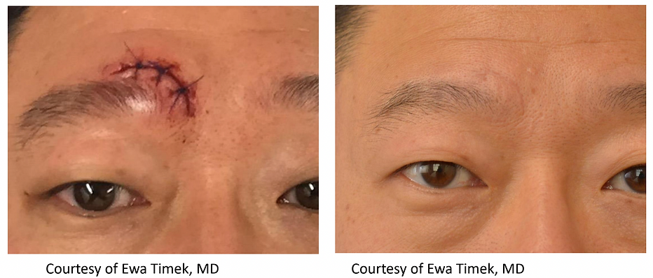 Pixel 8 Treatment in Astoria