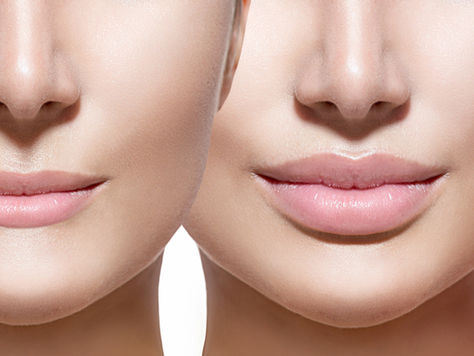 The Art of Lip Fillers in Astoria NY: Everything You Need to Know Before Your Treatment