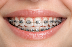 Bracketts