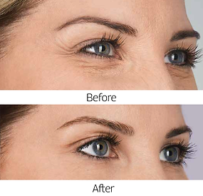 Botox-4.png