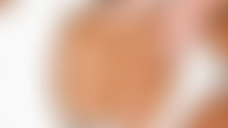 Desafios Pós-Cirúrgicos: Estratégias Estéticas para Combater as Fibroses