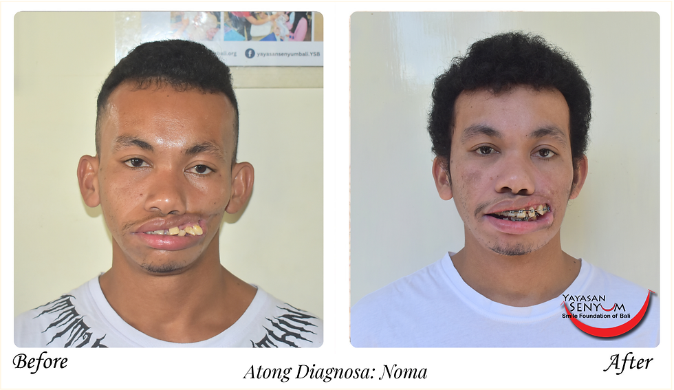 Noma - Kelainan Wajah - Yayasan Senyum Bali