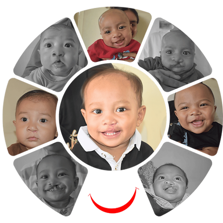Free Cleft Lip & Palate Surgery Program - Yayasan Senyum Bali