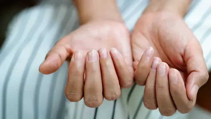 Nails' issues