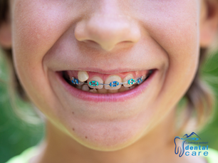 5 Signs You Should Book a Children’s Orthodontic Assessment This Summer