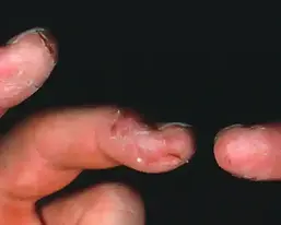 Finger tip ecz copy.webp