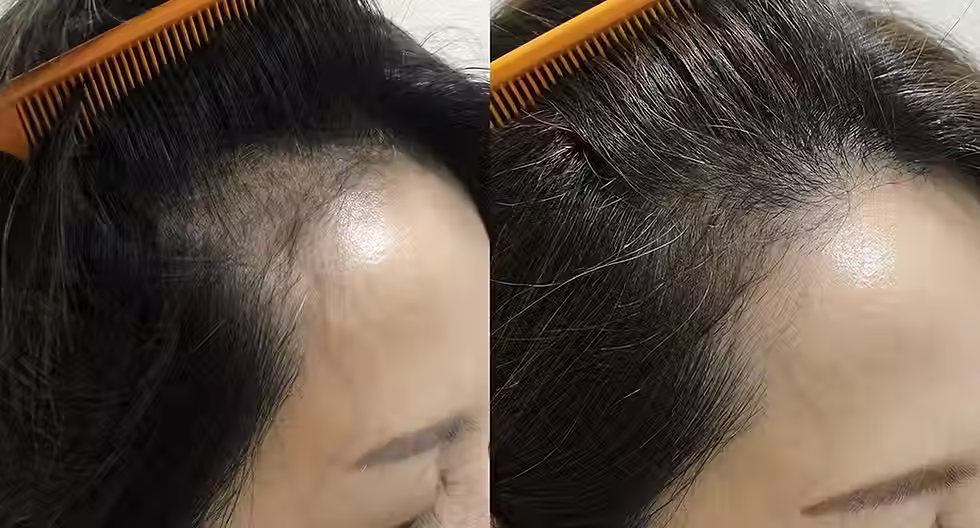 真實客戶葉小姐—頭髮稀疏