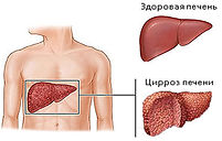 цирроз печени