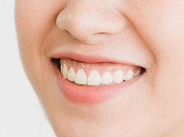 gummy-smile.jpg