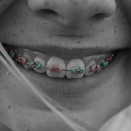 Braces