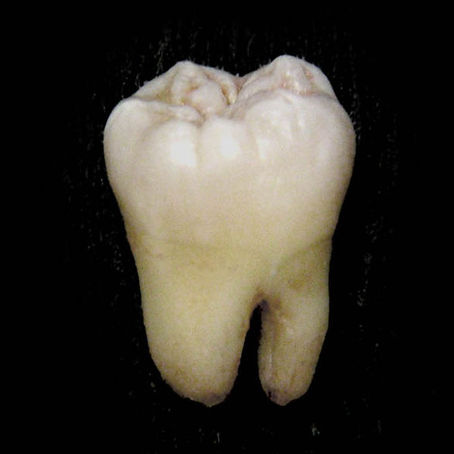 Wisdom Teeth