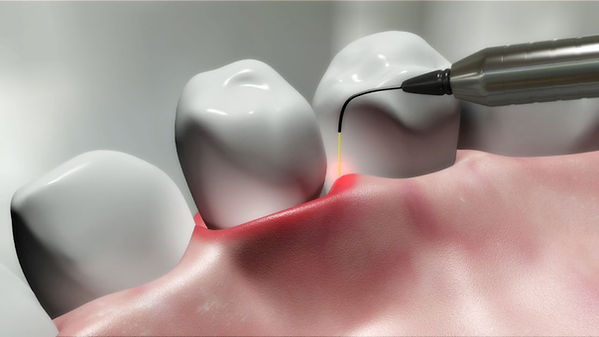 Laser-in-dentistry_1.jpeg