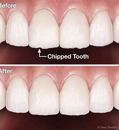 Contouring and Reshaping Teeth: A Guide to Perfecting Your Smile