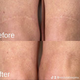 Surgery scar camouflage: restorative permanent makeup La Jolla