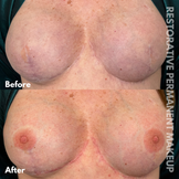 Post Mastectomy restorative tattooing SAN DIEGO