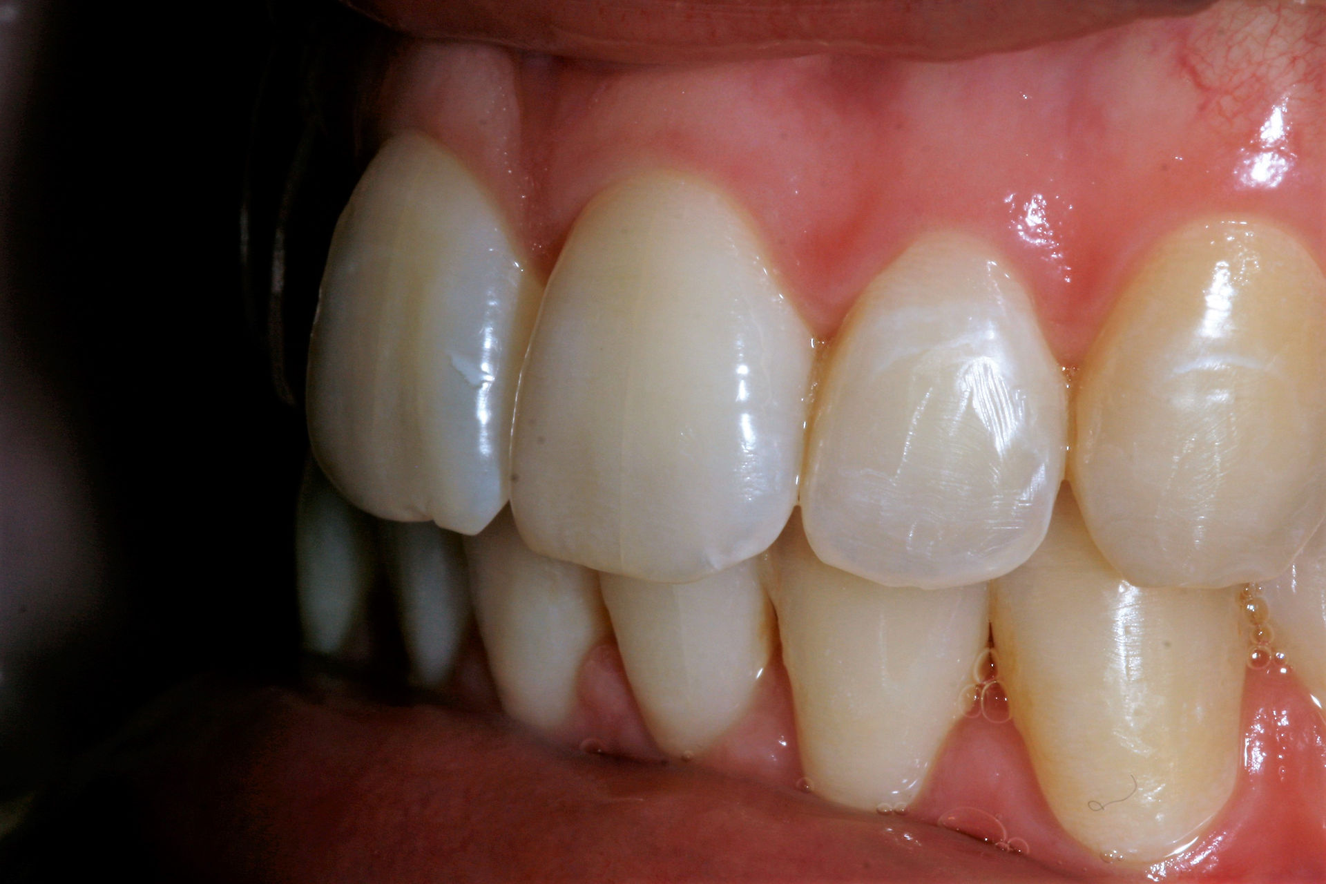 Invisalign Broad Street Dental Surgery Hereford, Herefodshire