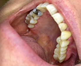 Taka-alueen siltacase