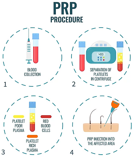 PRP Process.PNG