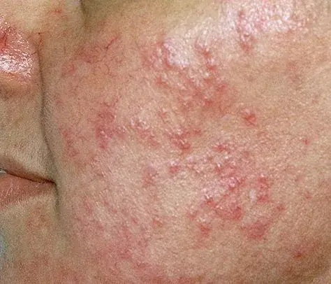 Rosacea and Sensitive Skin Treatments in Keizer, Oregon