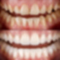 Aesthetic smile design treatment in dental dentistry. E-Max and zirconium porcelain crowns