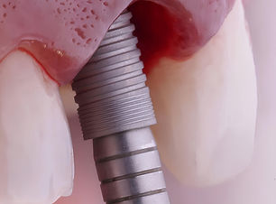 Intraosseous dental implant treatment. Bone grafting for tooth loss and intraosseous cylin