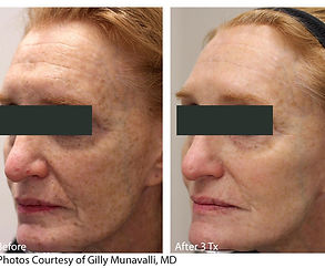 Lutronic_treatment_results.jpg