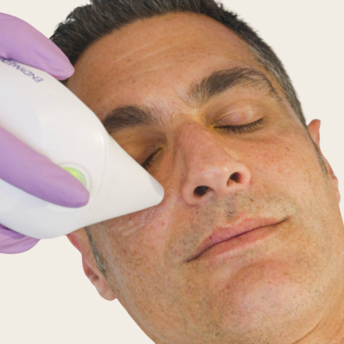 Client receiving iFine Eyes EndyMed treatment at Skin Re-Treat, Lichfield. Targets tightening and lifting of the eye area, addressing crow’s feet, eye bags, fine lines, and wrinkles.