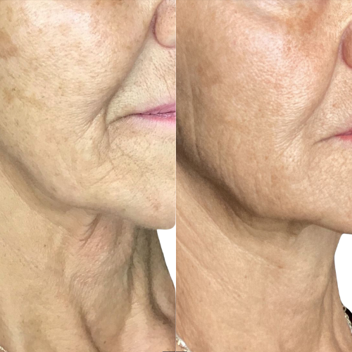 Before and after photos of client who received EndyMed treatment on cheeks, jowls, and neck at Skin Re-Treat, Lichfield. Treatment tightens, lifts, and shapes lax, sagging skin.