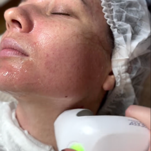 Client receiving EndyMed treatment on cheeks and neck at Skin Re-Treat, Lichfield. Tightens, lifts, and shapes lax and sagging skin in these areas.