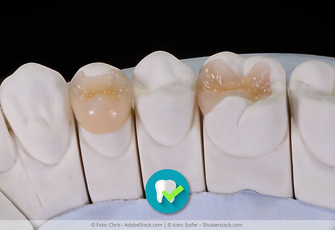 111d_zahnerhaltung_inlay_keramik_zahnarztpraxis__ZAHNZENTRUM_HERNE_DRES_SZOSTAK.jpg