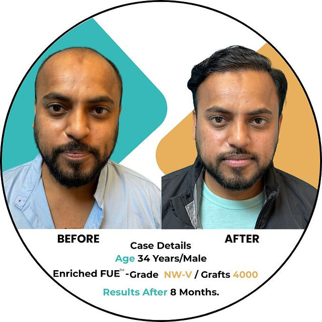 hair transplant in delhi