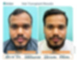 Hair Transplant Delhi