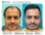 hair transplant results