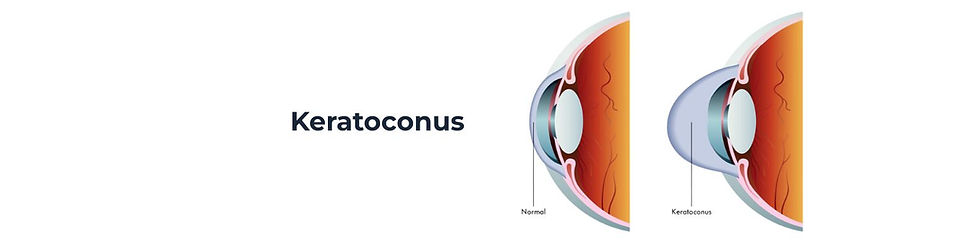 Keratoconus treatment in Gurgaon