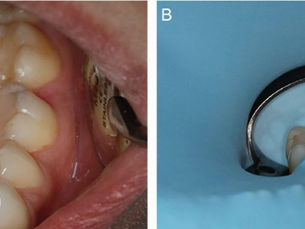 Rubber Dam Isolation: Techniques, Benefits & Common Mistakes
