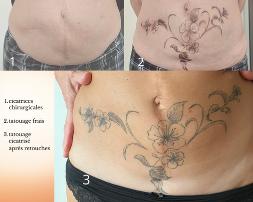 tatouage sur cicatrices, tatouage végétal, tatouage floral, tatouage de fleurs de pommier, tatouage fineline